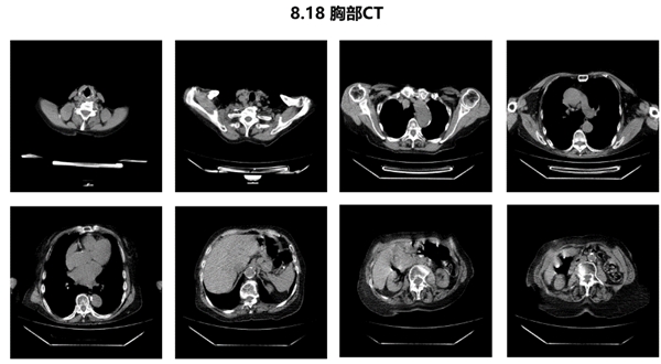 新冠病毒复阳CT值 新冠病毒ct值 阳性